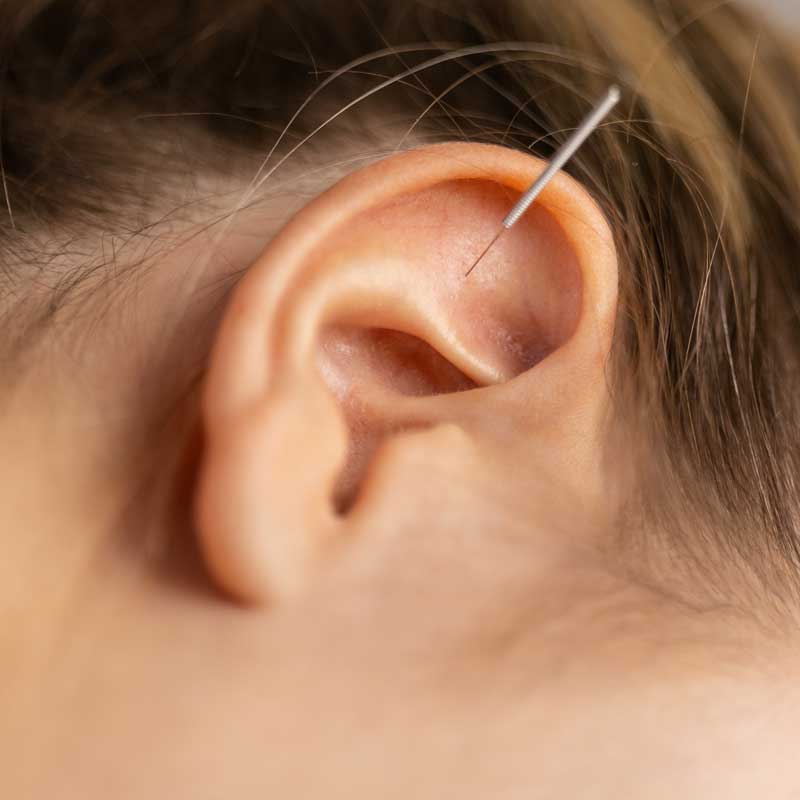 Ohrakupunktur in der HNO Praxis Preetz